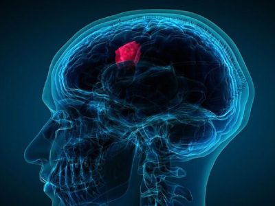 انواع تومورهای مغزی و درمان آنها