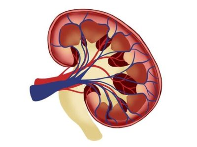 چگونه خطر سنگ کلیه را کاهش دهیم؟