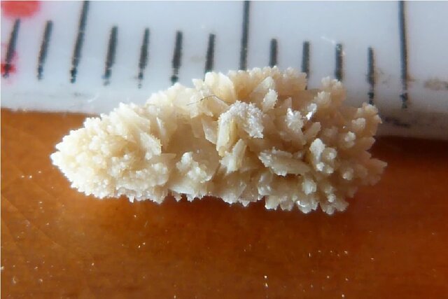 رباتی که سنگ کلیه را دفع می‌کند