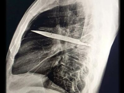 چاقویی که هشت سال در «سینه» مخفی مانده بود