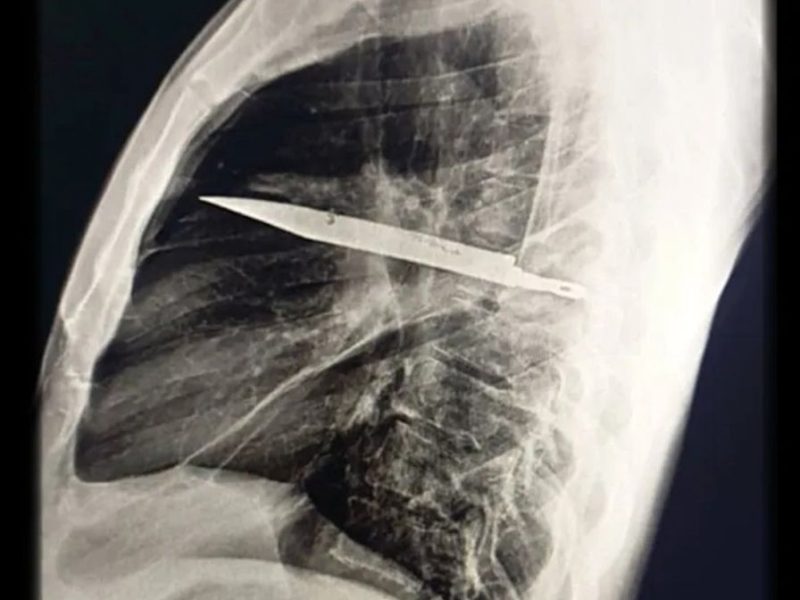 چاقویی که هشت سال در «سینه» مخفی مانده بود