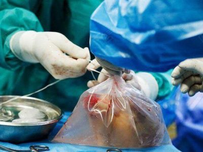 نخستین اهدای عضو گیلان درسال جاری  ثبت شد